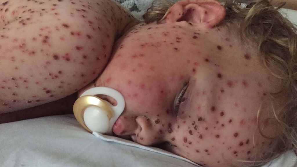 Pictures of Viral Skin Diseases and Problems - Chickenpox ...