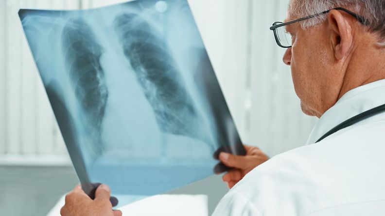Lääkäri keuhkosyöpä