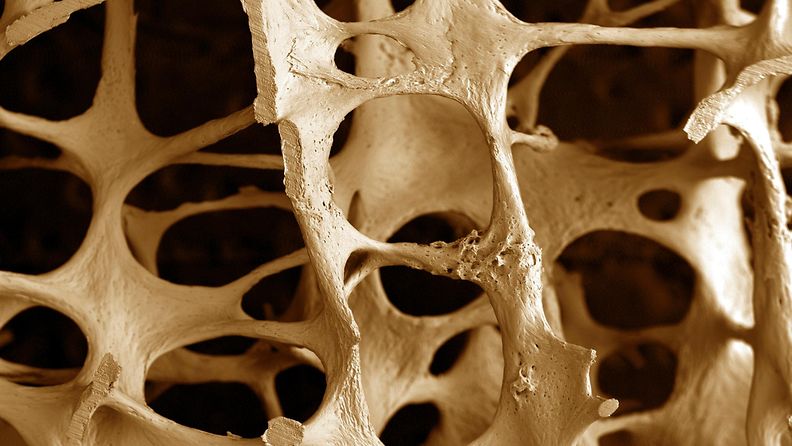 osteoporoosi (1)