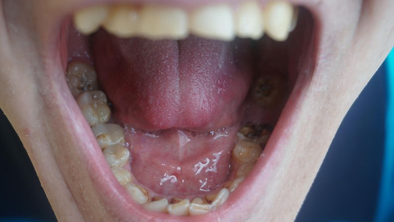 hampaat