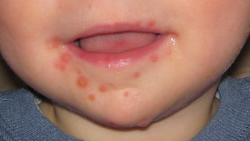 Hand_Foot_Mouth_Disease